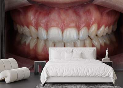 upper jaw with gum for resection for a perfect smile Wall mural