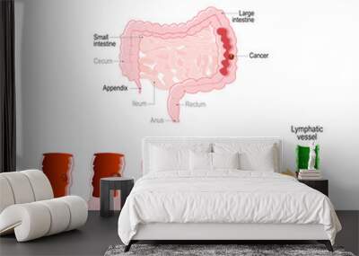 colon cancer. Colorectal oncology. Stages of Development a malignant tumor Wall mural