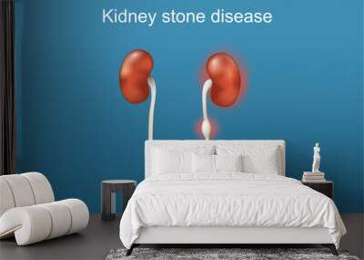 Kidney stone disease Wall mural