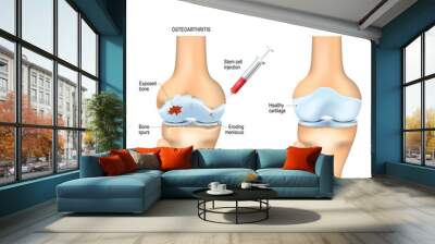 Stem cell therapy for pain in osteoarthritis Wall mural