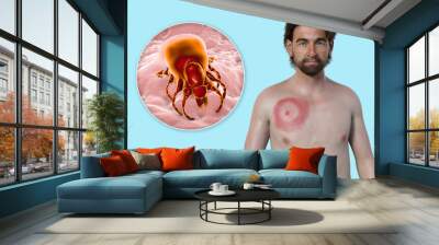 A man with erythema migrans, a characteristic rash of Lyme disease caused by Borrelia burgdorferi, 3D illustration Wall mural