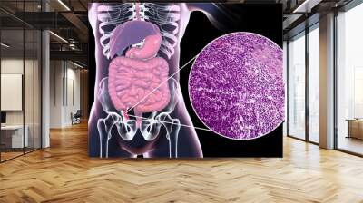 Acute appendicitis, 3D illustration of human body with inflammed appendix and light micrograph, photo under microscope Wall mural