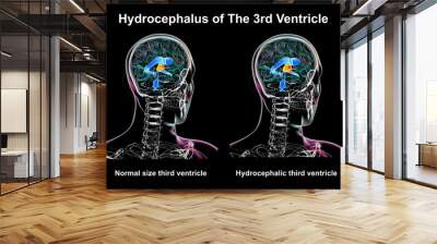 Enlargement of the third brain ventricle, 3D illustration Wall mural