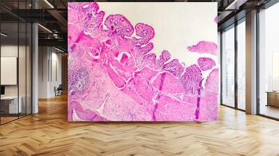 Photomicrograph of chronic cholecystitis Wall mural