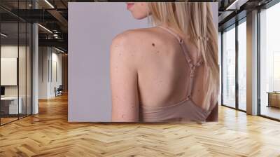 Checking benign moles : Beautifull Woman with birthmarks on her back and face. Laser skin tags removal Wall mural