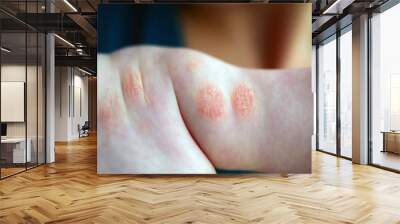 Atopic dermatitis in a child Wall mural