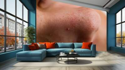 close up has skin problem, large pores, whitehead and blackhead pimple Wall mural