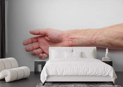 On white isolated background lies mans hand scratched by rabid cat. Medical care, hydrogen peroxide Wall mural