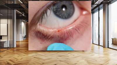 close up of the eyelid nevi during eye examination. Wall mural