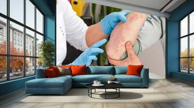 A dermatologist wearing gloves examines the skin of a sick patient. Examination and diagnosis of skin diseases-allergies, psoriasis, eczema, dermatitis Wall mural