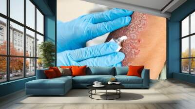 The use of emollient for dry flaky skin, as well as in the treatment of psoriasis, eczema and other diseases of dry skin. Wall mural