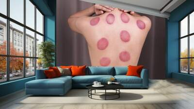 woman receiving cupping treatment on back Wall mural