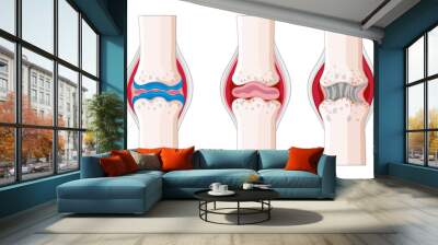 Rheumatoid arthritis in human body Wall mural