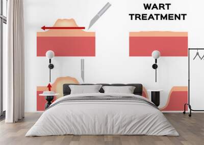 wart treatment . remove it from skin by surgery vector callus Wall mural