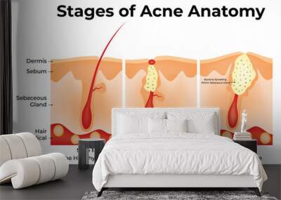 Stages of Acne Anatomy Science Design Vector Illustration Diagram Wall mural