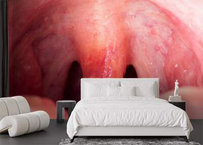 Inflammation of the uvula in the oral cavity due to infection and virus. Treatment of the disease is uvulitis. Red throat due to illness, close-up Wall mural