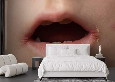 slit-like impetigo in a little girl in the corners of her mouth. Skin wounds. Dermatological bacterial disease. Sticky lips, close-up Wall mural