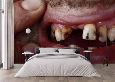 Unhealthy teeth Wall mural