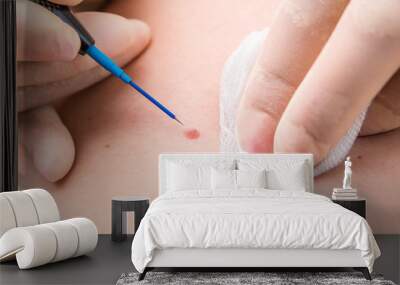 Professional medical removal of a birthmark on the back of a patient. Close-up Wall mural