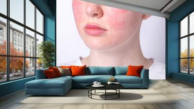 rosacea couperose redness skin, red spots on cheeks, young woman with sensitive skin, patient face close-up  Wall mural