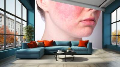 rosacea couperose redness skin, red spots on cheeks, young woman with sensitive skin, patient face close-up Wall mural