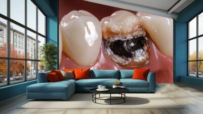 Tooth with caries. Dental health concept Wall mural