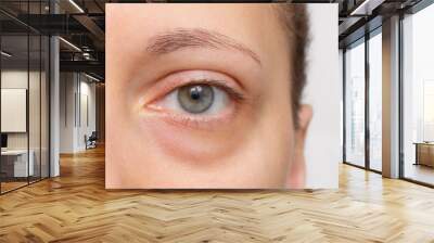 The face of a young woman with a bag under her eye close-up. Swelling of the lower eyelid. Bruises and dark circles appear from insomnia, stress, depression, overwork and fatigue. Unhealthy appearance Wall mural