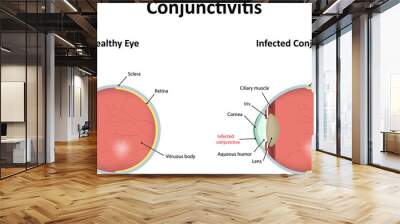 Conjunctivitis Illustration Wall mural