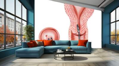 Biopsy of the cervix and endocervix. Wall mural