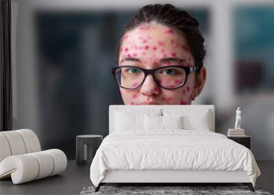 Chickenpox adult girl covered in skin inflammation. Wall mural