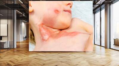 medical procedure dressing a boy with a first-degree burn from boiling water on his face, neck and chest Wall mural