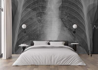 X-Ray chest lung Male 77year old abscess lung with pneumonia Wall mural