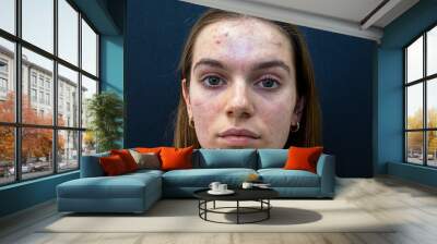 Closeup of an irritated young woman face skin after a cosmetic procedure. Red skin. Problem with face. Facial pain. Wall mural