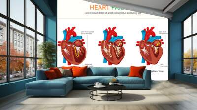 Heart failure or congestive heart failure Wall mural