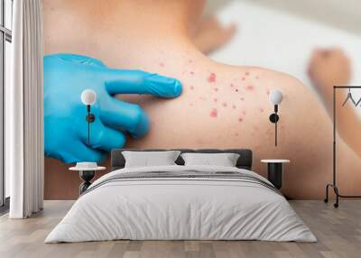 Teenage acne-acne on the shoulder of a young man at a doctor's appointment in a clinic for the treatment of a problem. Wall mural