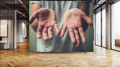 Young man with hand foot and mouth disease Wall mural