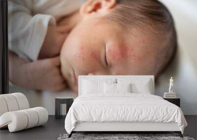 newborn skin acne  Wall mural