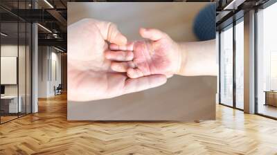 Burned hand of small child Wall mural