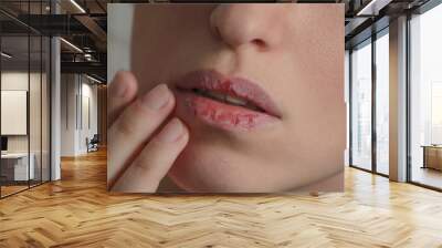 Dermatillomania skin picking. Woman has bad habit to picks her lips. Harmful addiction based on anxiety stress and dry lips. Excoriation disorder. Sick cracked damaged tissue. Wall mural