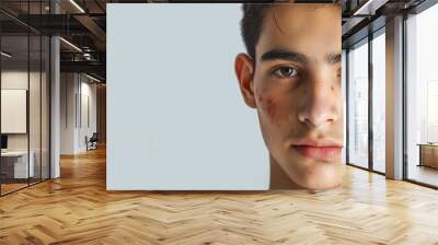 Banner with curly-haired brunette young latin american man on solid background, face with skin problems. Copy space, close-up. Acne, pimples, acne treatment, hormonal failure, cosmetology. Wall mural