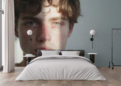 Close-up of young teenager with severe rosacea skin problems Wall mural