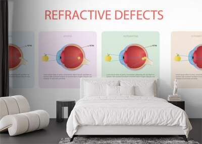 Refractive errors of vision,myopia,hyperopia,astigmatism Wall mural