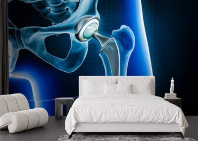 Femoral head hip prosthesis or implant. Total hip joint replacement surgery or arthroplasty 3D rendering illustration. Medical and healthcare, arthritis, pathology, science, osteology concepts. Wall mural