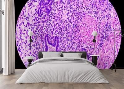 Microphotograph of endometrial tissue, reveals decidual change with necrosis and hemorrhage. Endometriosis. Endometrial or uterine cancer diagnosis. Wall mural