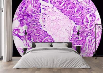 Thyroid cancer: Microscopic image of Metastatic papillary carcinoma of thyroid. Reactive change. Lymph node carcinoma. Wall mural