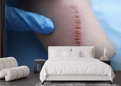 Doctor in rubber protective gloves examining patient scar in clinic closeup Wall mural