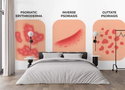 psoriasis. allergic eczema types, rashes treatment. dermatology infectious spots, skin disease. epid Wall mural