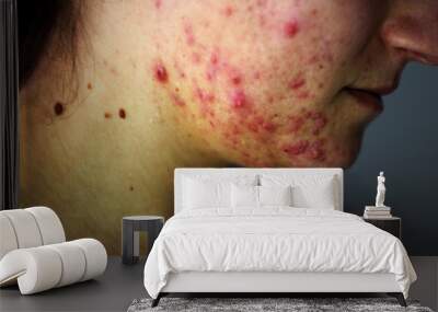 Allergy concept,young girl with problematic pimple on the face.-image. Wall mural