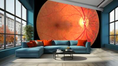 View inside human eye disorders - showing retina, optic nerve and macula.Medical photo tractional retinal detachment of diabetes.Eye treatment concept.select focus. Wall mural