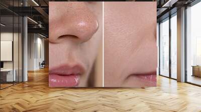 Blackhead treatment, before and after. Collage with photos of woman, closeup view Wall mural